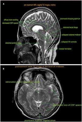 Spontaneous Intracranial Hypotension Presenting With Frontotemporal Dementia: A Case Report